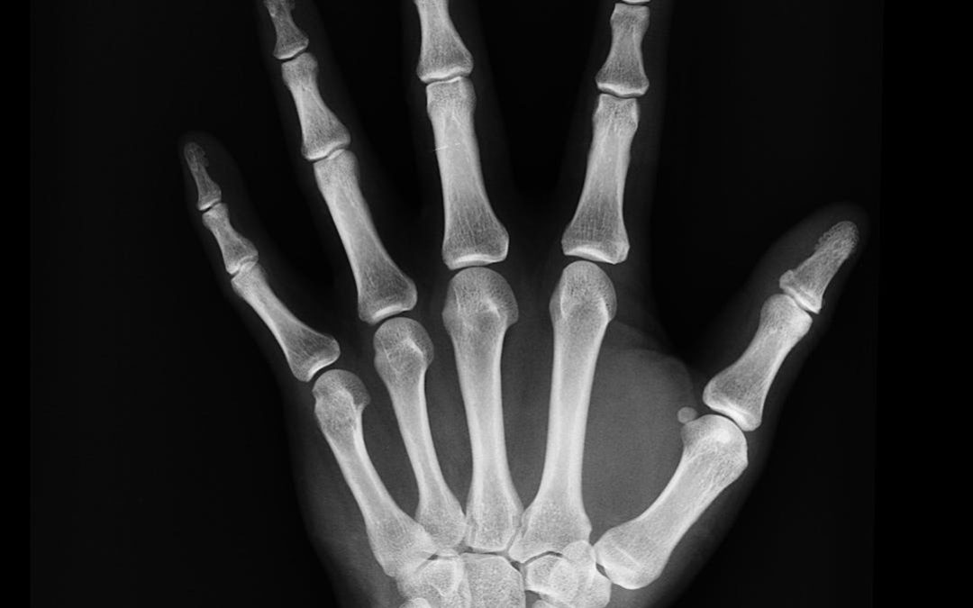 black and white bones hand x ray